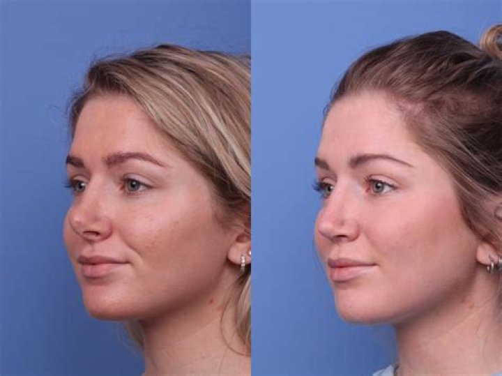 Did Herlene Nicole Budol Have A Nose Rhinoplasty Surgery? Details About Her Plastic Surgery